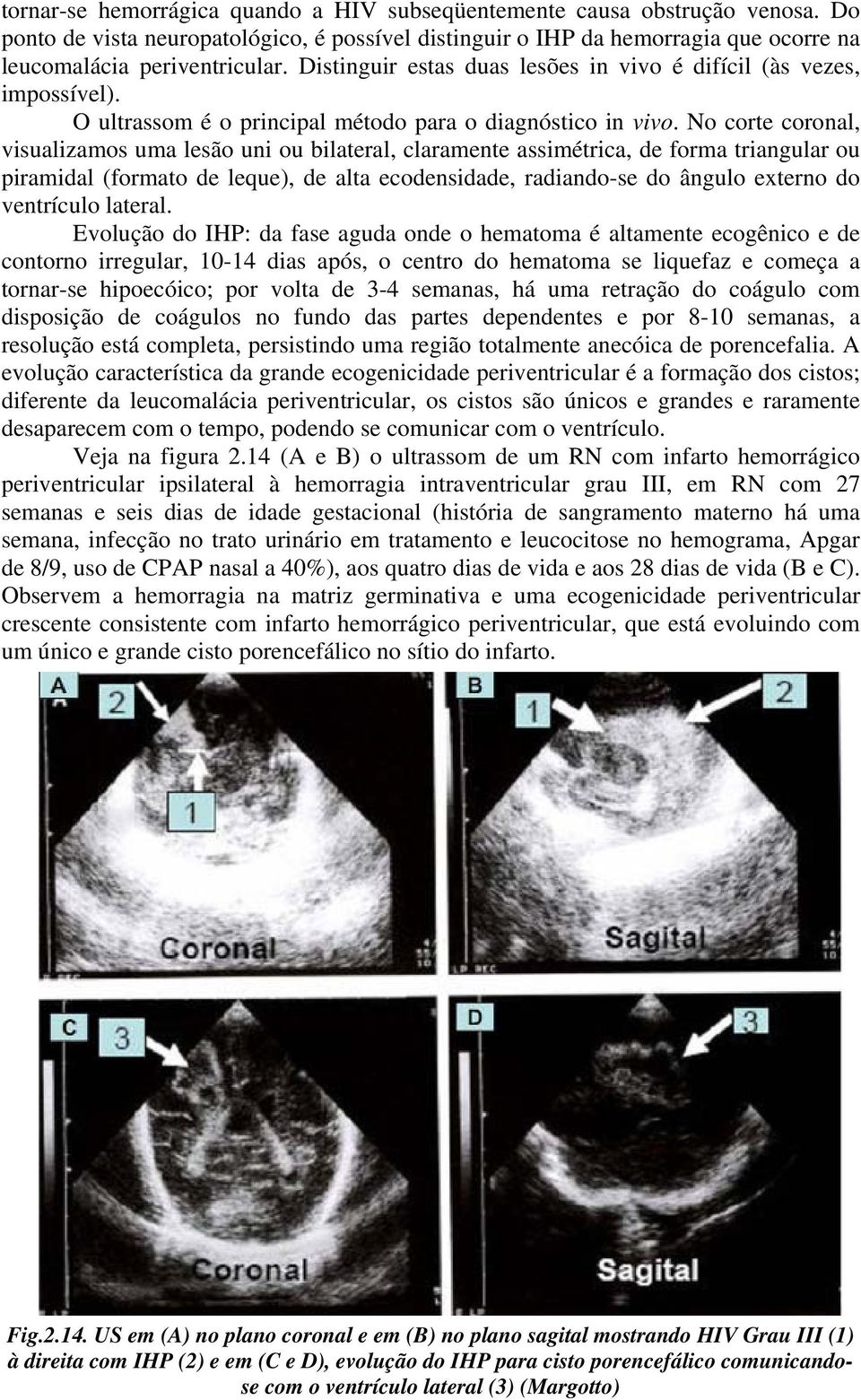 No corte coronal, visualizamos uma lesão uni ou bilateral, claramente assimétrica, de forma triangular ou piramidal (formato de leque), de alta ecodensidade, radiando-se do ângulo externo do