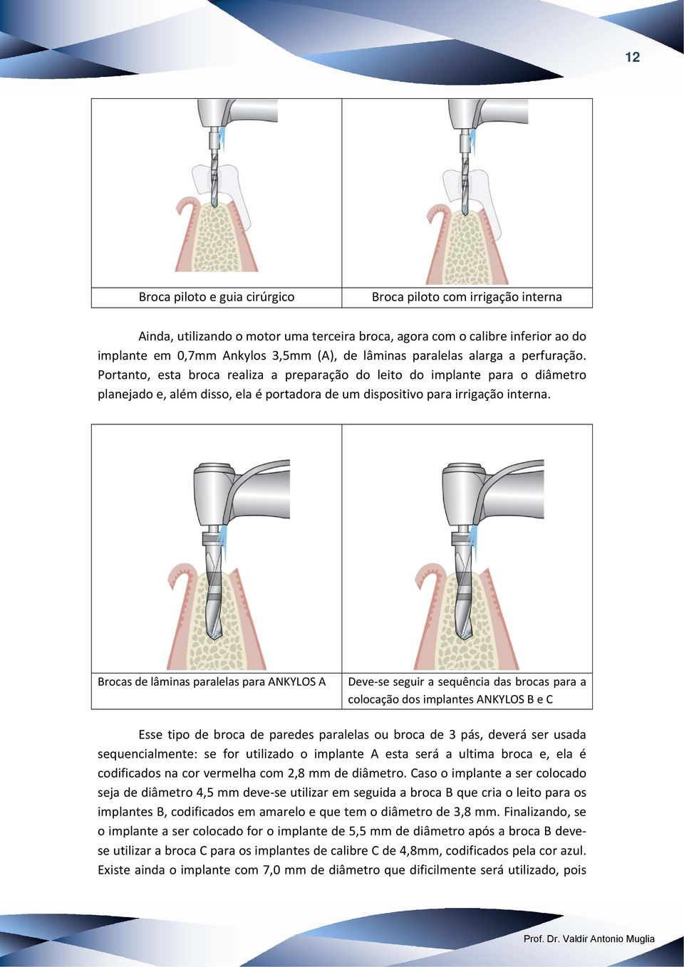 Brocas de lâminas paralelas para ANKYLOS A Deve se seguir a sequência das brocas para a colocação dos implantes ANKYLOS B e C Esse tipo de broca de paredes paralelas ou broca de 3 pás, deverá ser