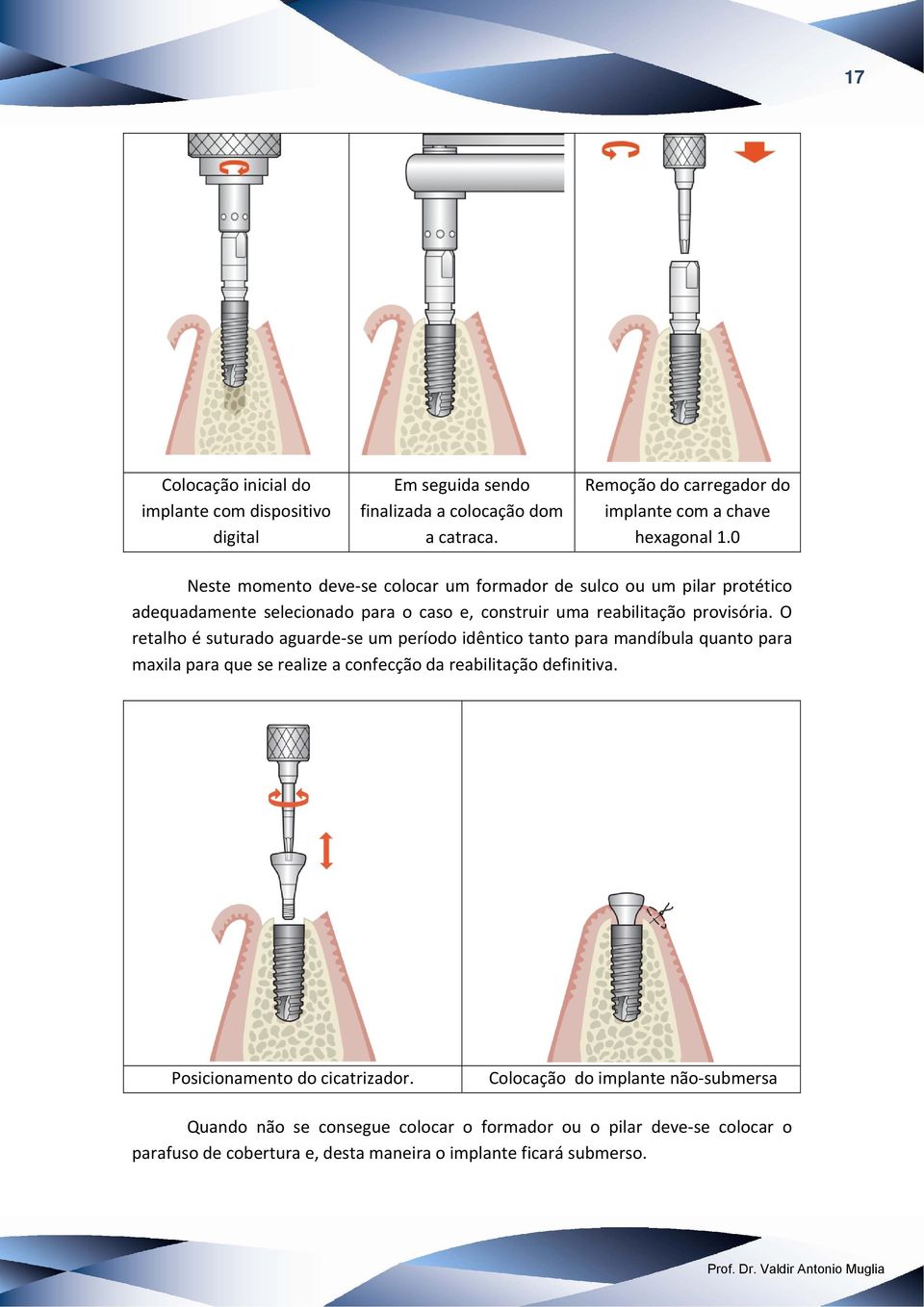 O retalho é suturado aguarde se um período idêntico tanto para mandíbula quanto para maxila para que se realize a confecção da reabilitação definitiva.