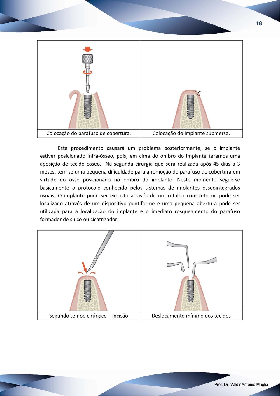 Na segunda cirurgia que será realizada após 45 dias a 3 meses, tem se uma pequena dificuldade para a remoção do parafuso de cobertura em virtude do osso posicionado no ombro do implante.