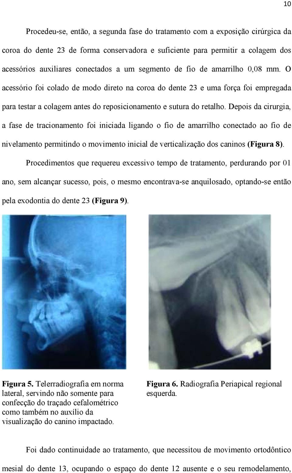 Depois da cirurgia, a fase de tracionamento foi iniciada ligando o fio de amarrilho conectado ao fio de nivelamento permitindo o movimento inicial de verticalização dos caninos (Figura 8).