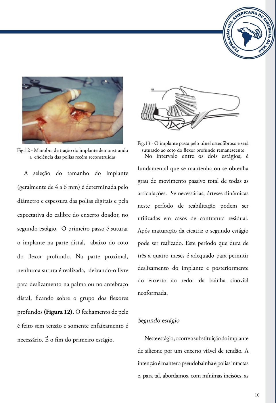 Na parte proximal, nenhuma sutura é realizada, deixando-o livre para deslizamento na palma ou no antebraço distal, ficando sobre o grupo dos flexores profundos (Figura 12).