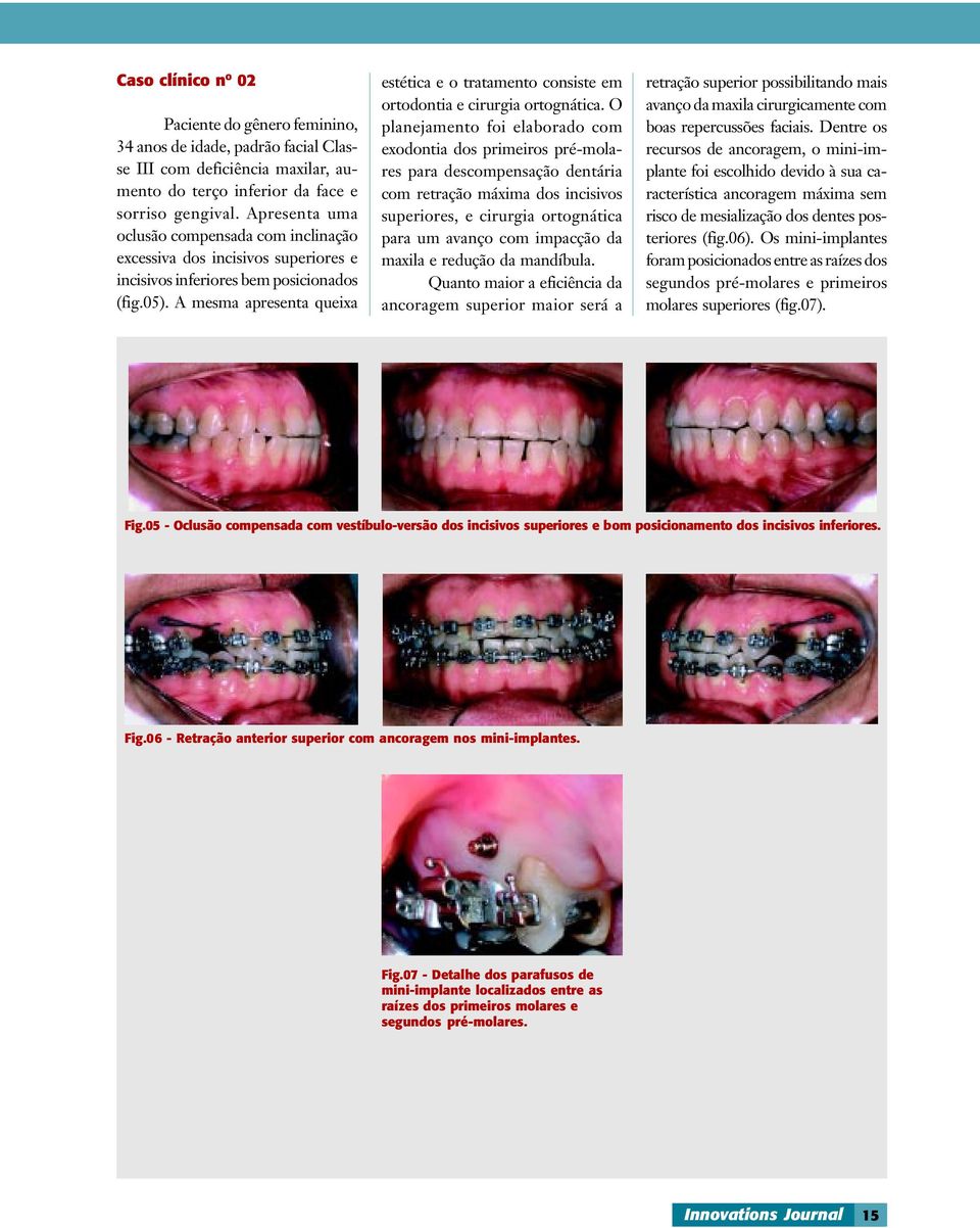 A mesma apresenta queixa estética e o tratamento consiste em ortodontia e cirurgia ortognática.