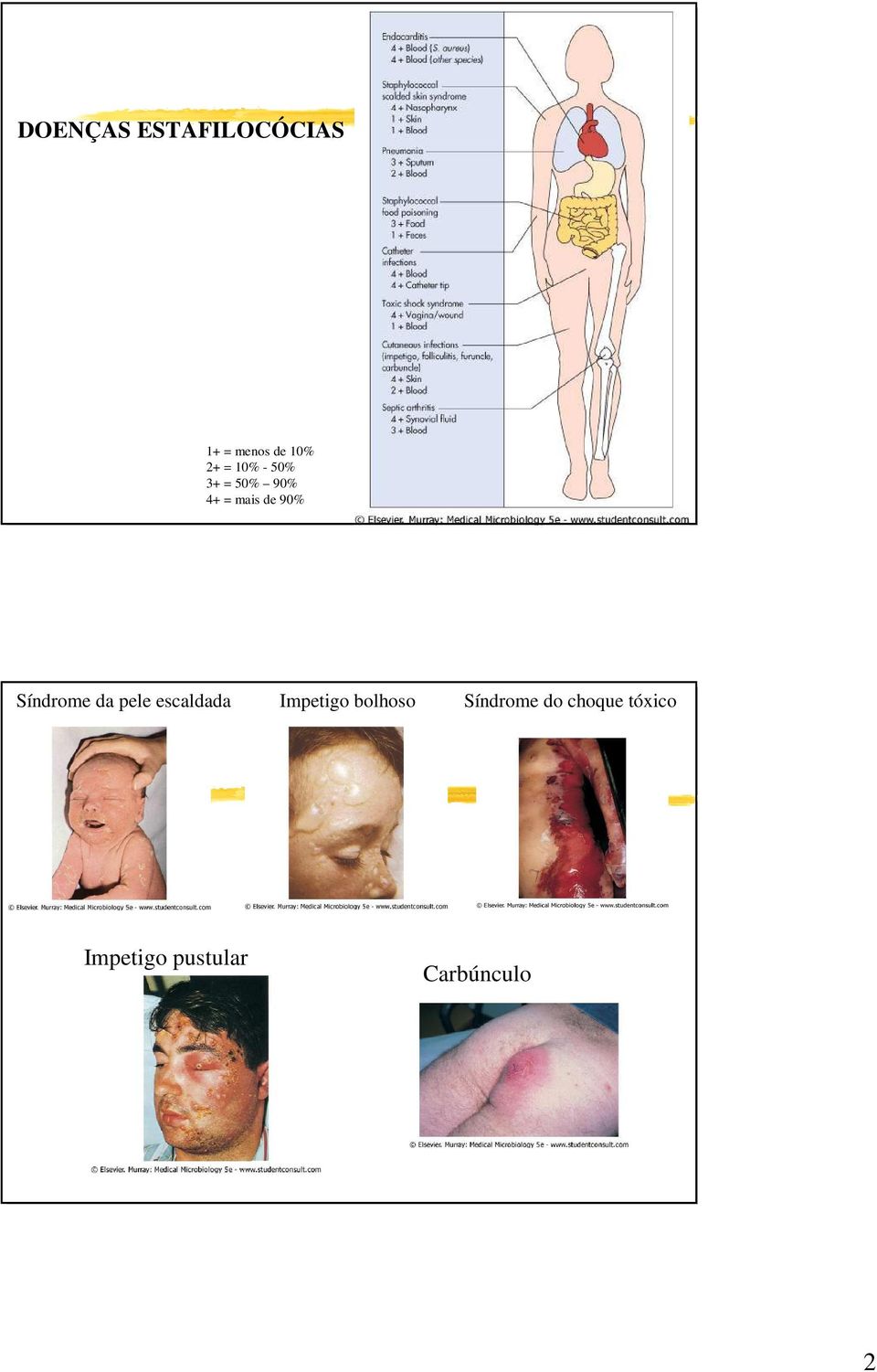 Síndrome da pele escaldada Impetigo bolhoso