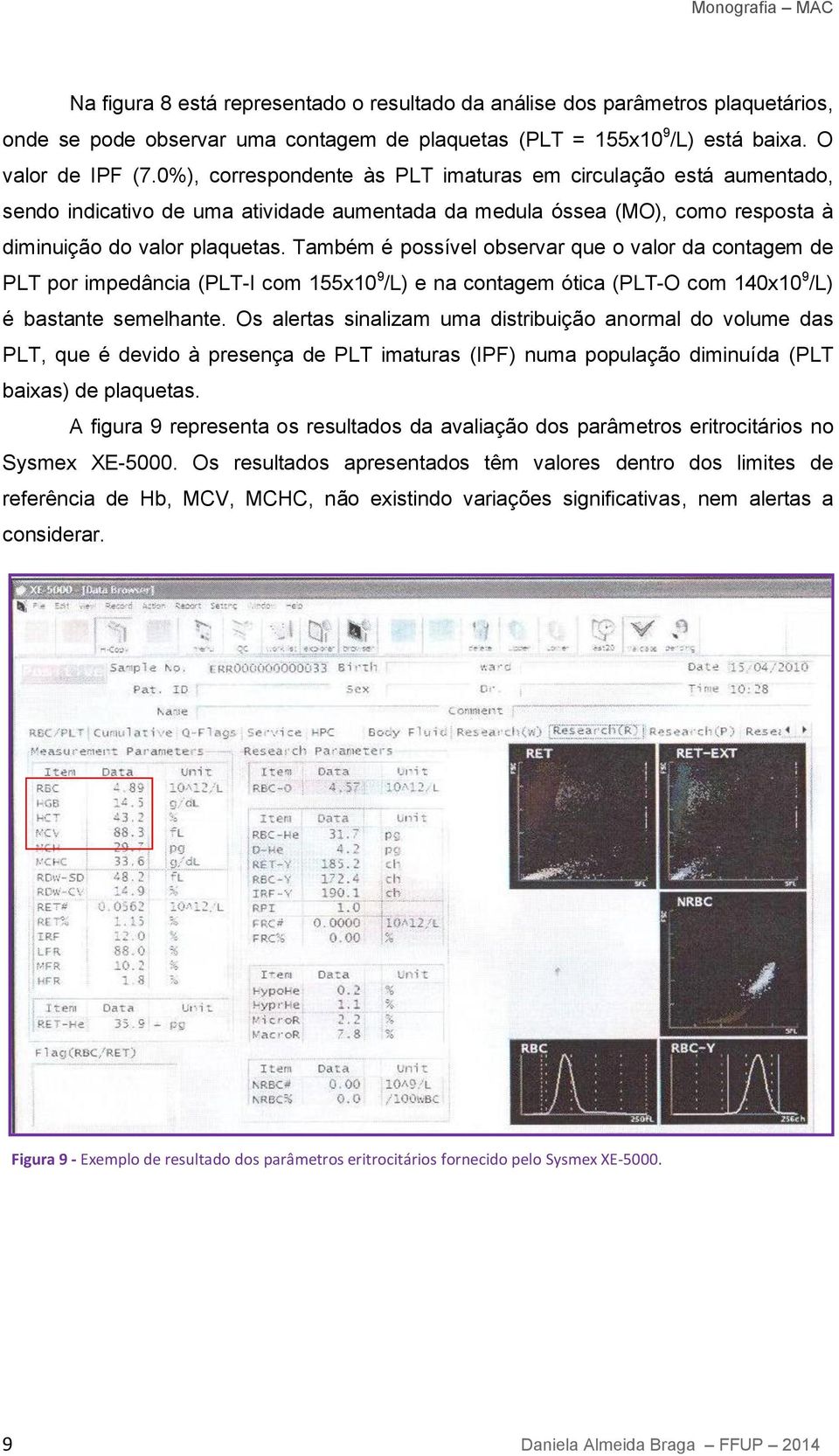 Também é possível observar que o valor da contagem de PLT por impedância (PLT-I com 155x10 9 /L) e na contagem ótica (PLT-O com 140x10 9 /L) é bastante semelhante.