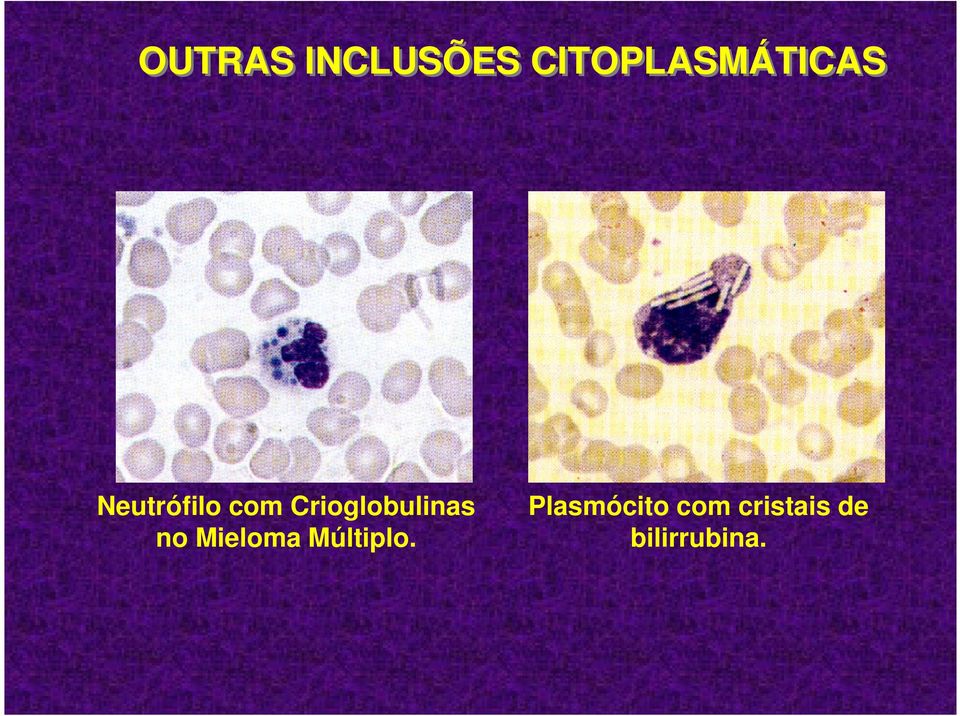 Crioglobulinas no Mieloma