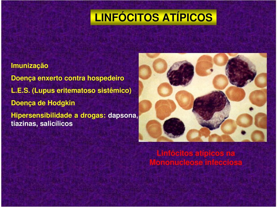 (Lupus eritematoso sistêmico) Doença de Hodgkin