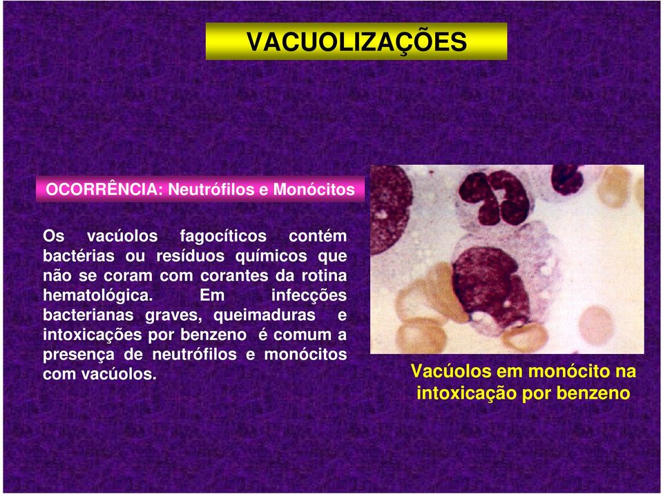 Em infecções bacterianas graves, queimaduras e intoxicações por benzeno é comum a