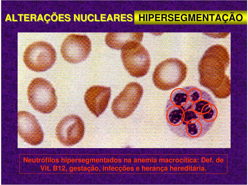 anemia macrocítica: Def. de Vit.