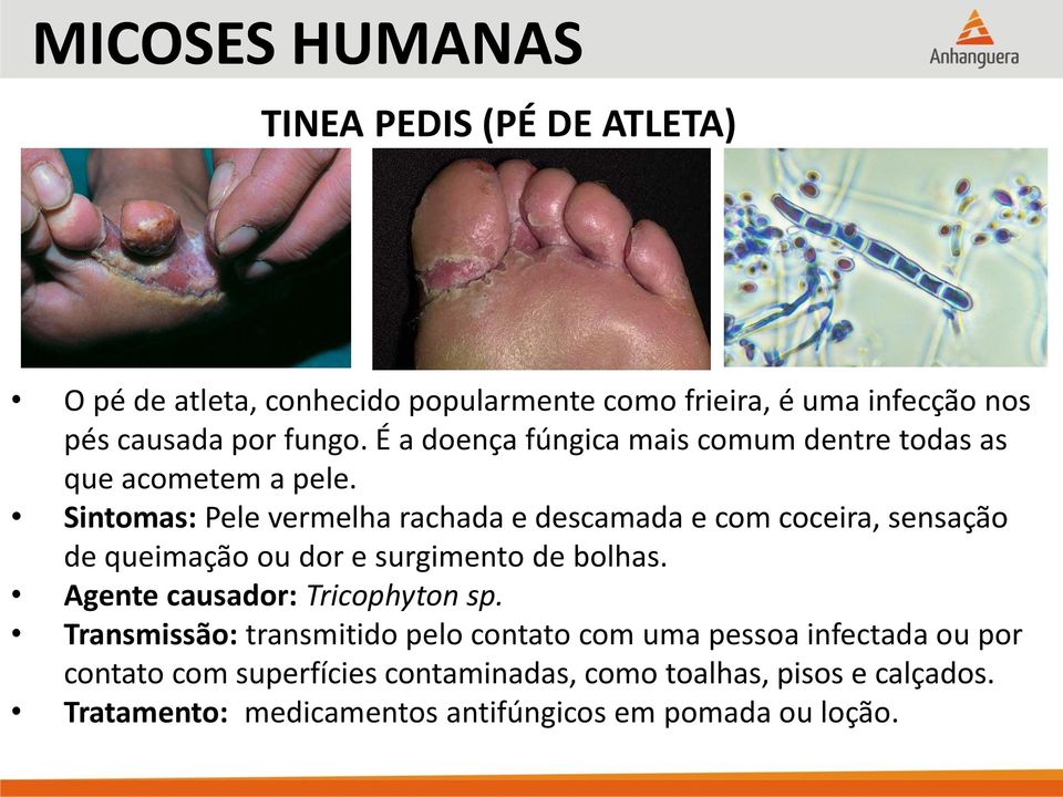 Sintomas: Pele vermelha rachada e descamada e com coceira, sensação de queimação ou dor e surgimento de bolhas.