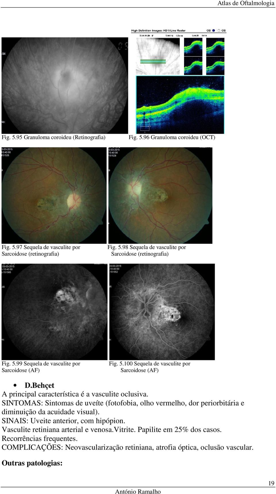 SINTOMAS: Sintomas de uveíte (fotofobia, olho vermelho, dor periorbitária e diminuição da acuidade visual). SINAIS: Uveite anterior, com hipópion.