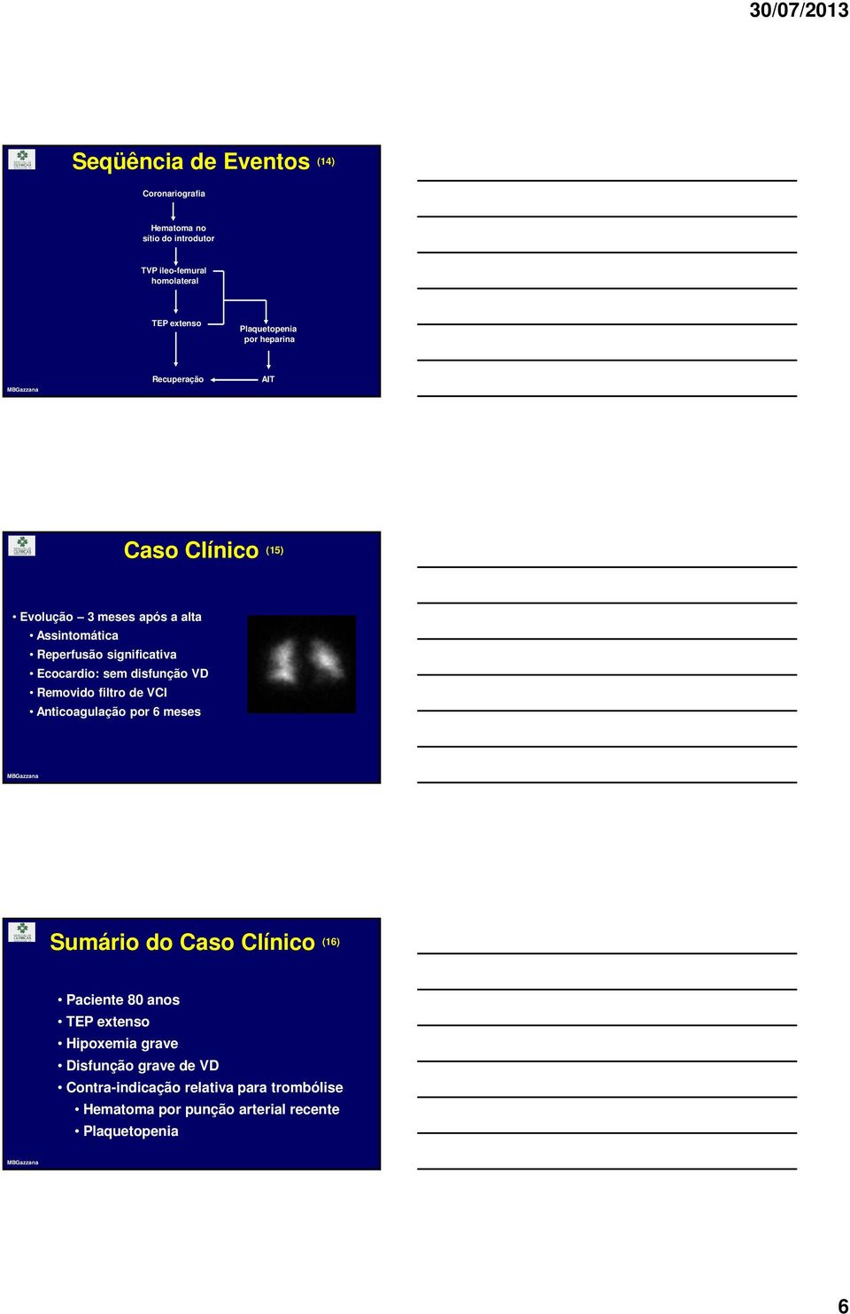 significativa Ecocardio: sem disfunção VD Removido filtro de VCI Anticoagulação por 6 meses Sumário do Caso Clínico (16)