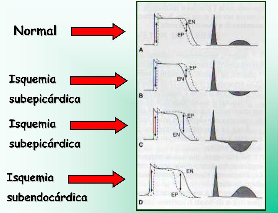 Isquemia  Isquemia