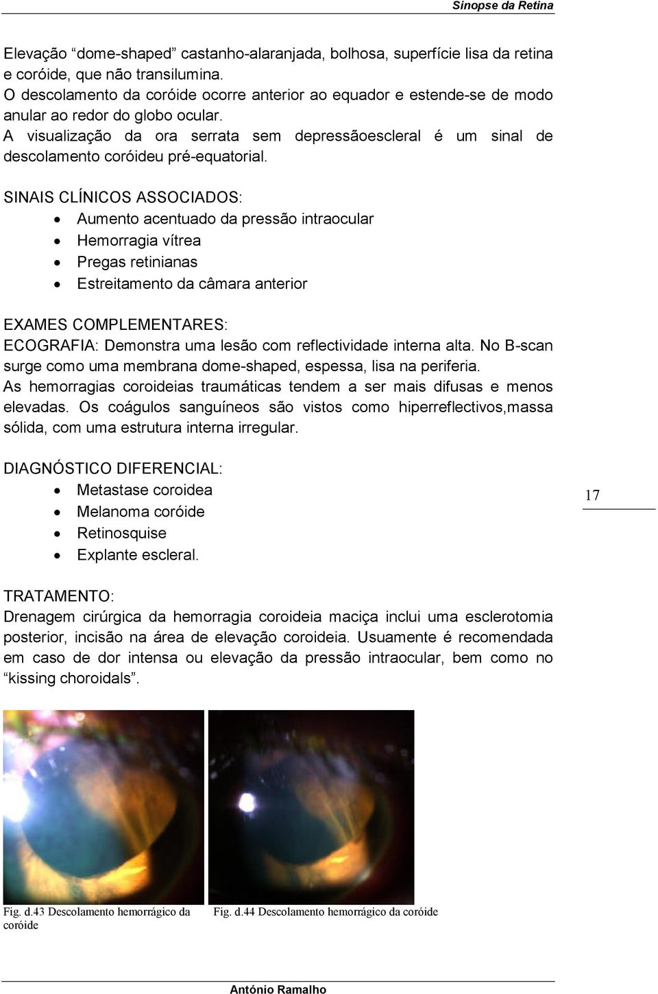 A visualização da ora serrata sem depressãoescleral é um sinal de descolamento coróideu pré-equatorial.