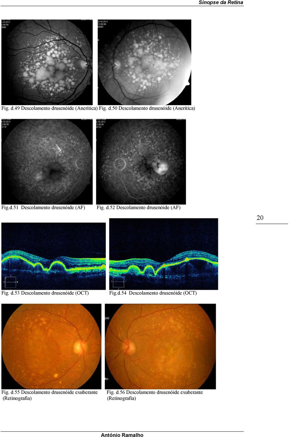 d.54 Descolamento drusenóide (OCT) Fig. d.55 Descolamento drusenóide exuberante (Retinografia) Fig.