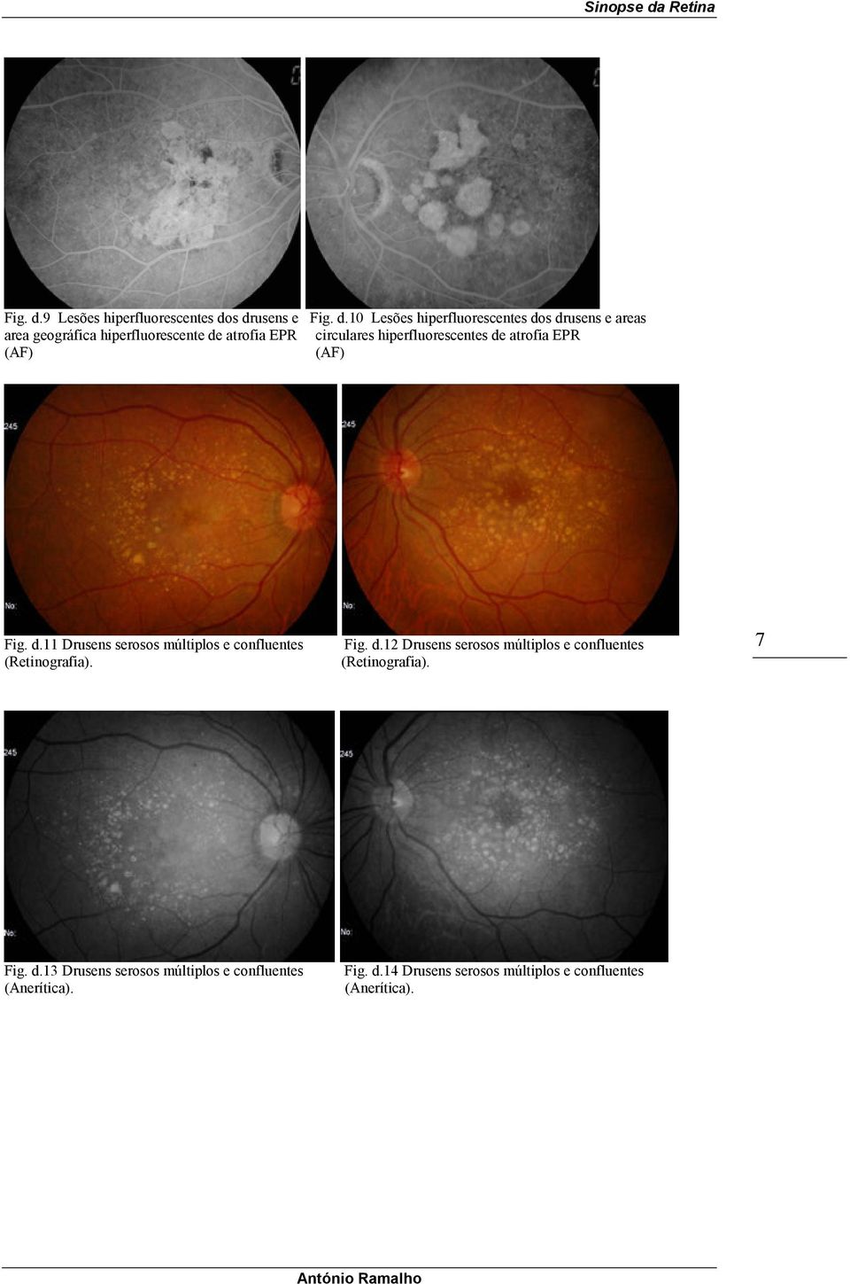 hiperfluorescente de atrofia EPR circulares hiperfluorescentes de atrofia EPR (AF) (AF) 11 Drusens serosos múltiplos