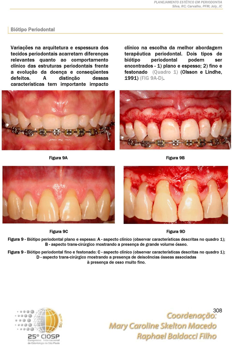 Dois tipos de biótipo periodontal podem ser encontrados - 1) plano e espesso; 2) fino e festonado (Quadro 1) (Olsson e Lindhe, 1991) (FIG 9A-D).