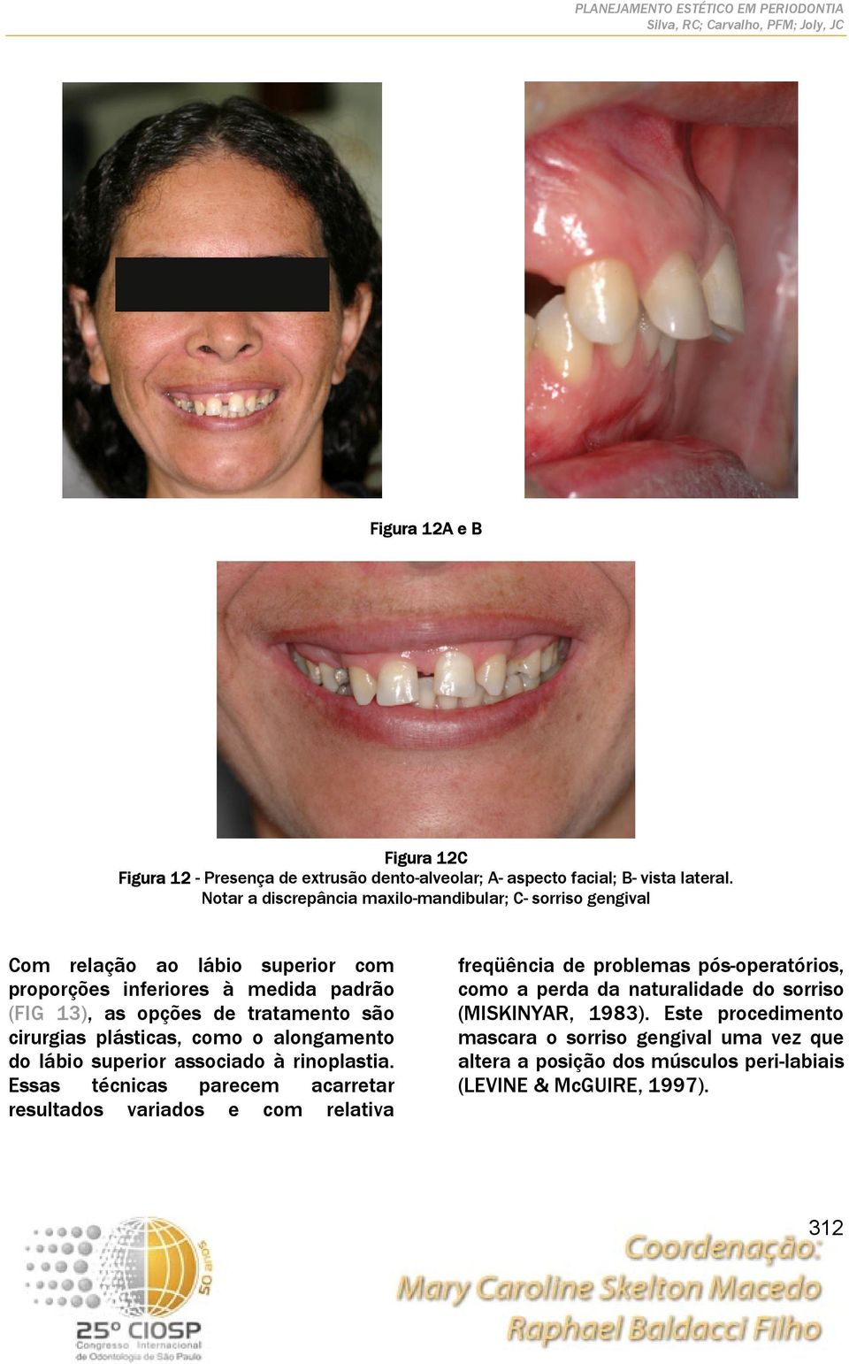 são cirurgias plásticas, como o alongamento do lábio superior associado à rinoplastia.