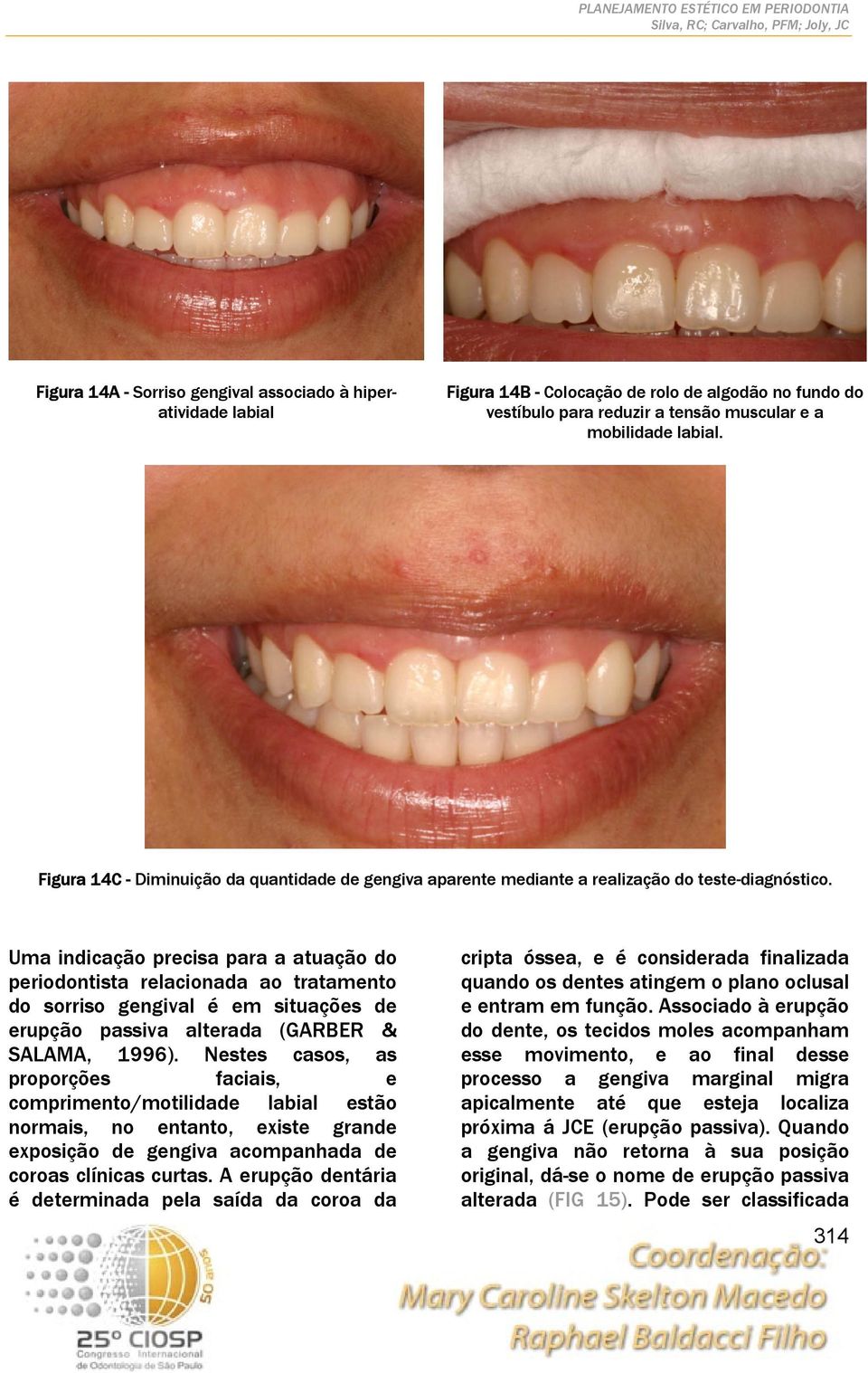 Uma indicação precisa para a atuação do periodontista relacionada ao tratamento do sorriso gengival é em situações de erupção passiva alterada (GARBER & SALAMA, 1996).