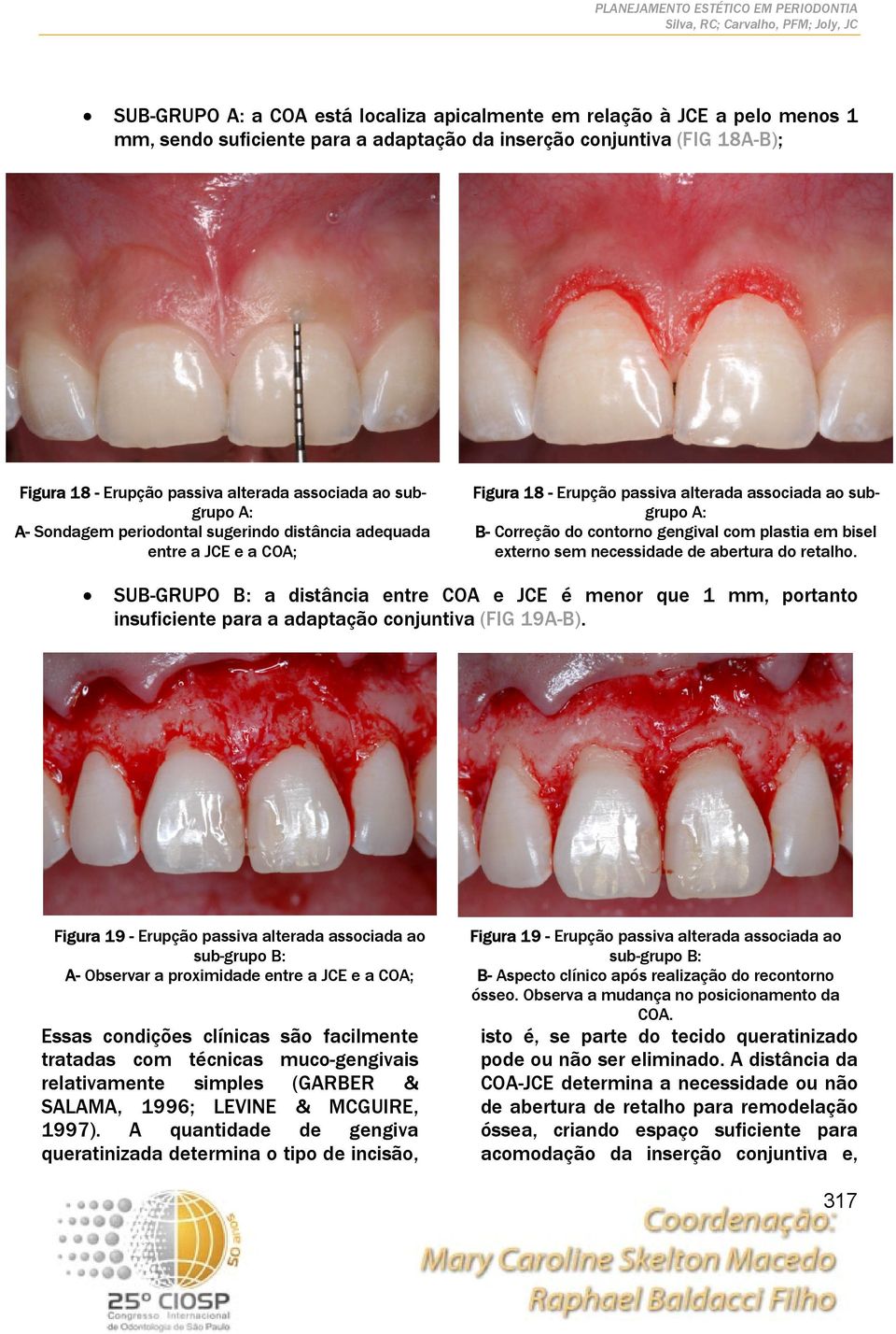 bisel externo sem necessidade de abertura do retalho. SUB-GRUPO B: a distância entre COA e JCE é menor que 1 mm, portanto insuficiente para a adaptação conjuntiva (FIG 19A-B).