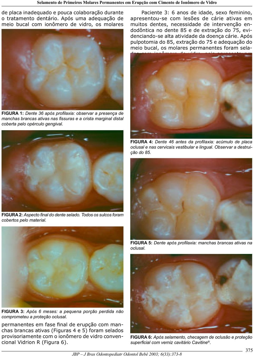 endodôntica no dente 85 e de extração do 75, evidenciando-se alta atividade da doença cárie.