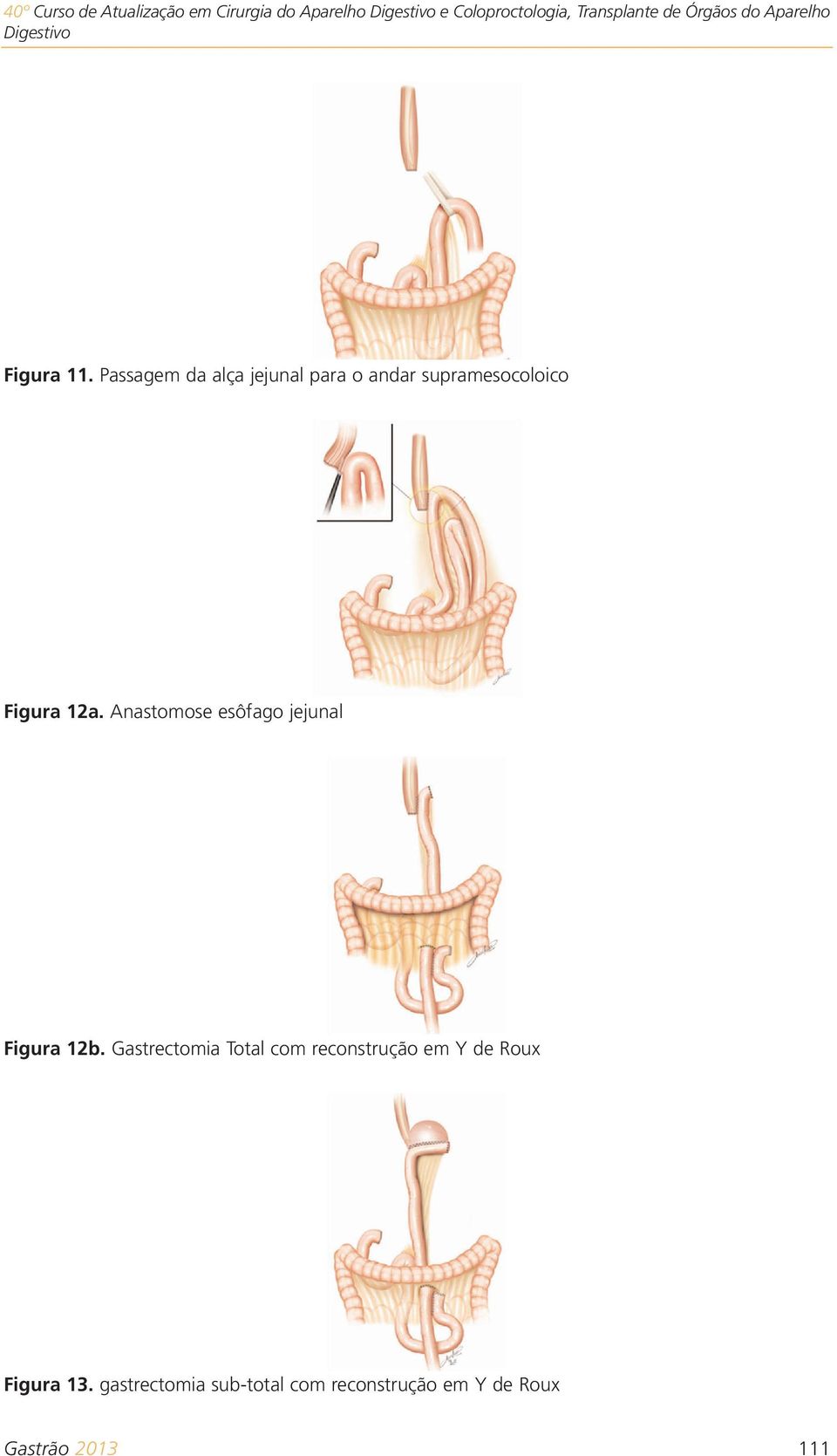 Passagem da alça jejunal para o andar supramesocoloico Figura 12a.
