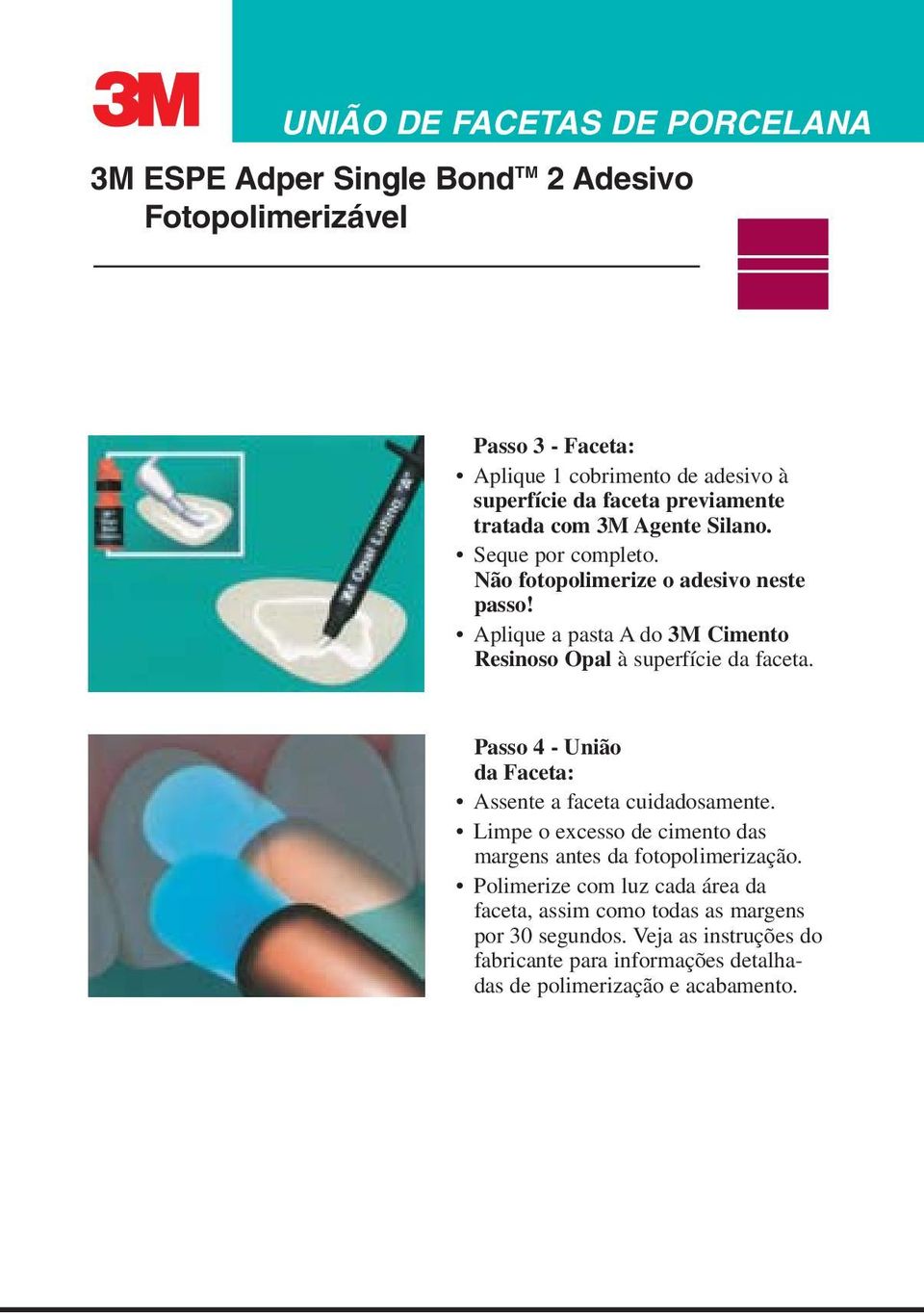 Passo 4 - União da Faceta: Assente a faceta cuidadosamente. Limpe o excesso de cimento das margens antes da fotopolimerização.