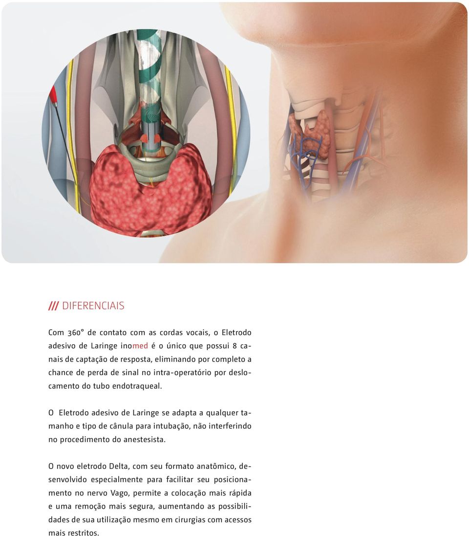 O Eletrodo adesivo de Laringe se adapta a qualquer tamanho e tipo de cânula para intubação, não interferindo no procedimento do anestesista.