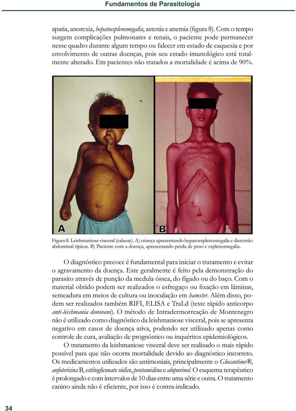 imunológico está totalmente alterado. Em pacientes não tratados a mortalidade é acima de 90%. Figura 8. Leishmaniose visceral (calazar).