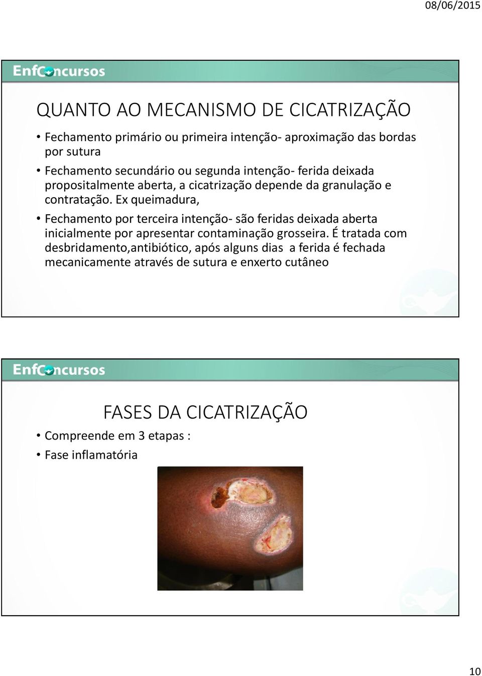 Ex queimadura, Fechamento por terceira intenção- são feridas deixada aberta inicialmente por apresentar contaminação grosseira.