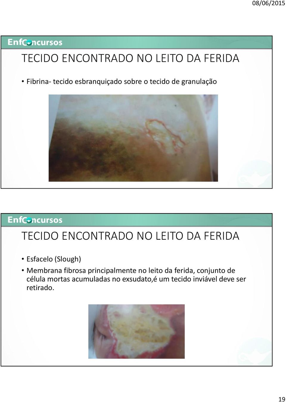 (Slough) Membrana fibrosa principalmente no leito da ferida, conjunto de