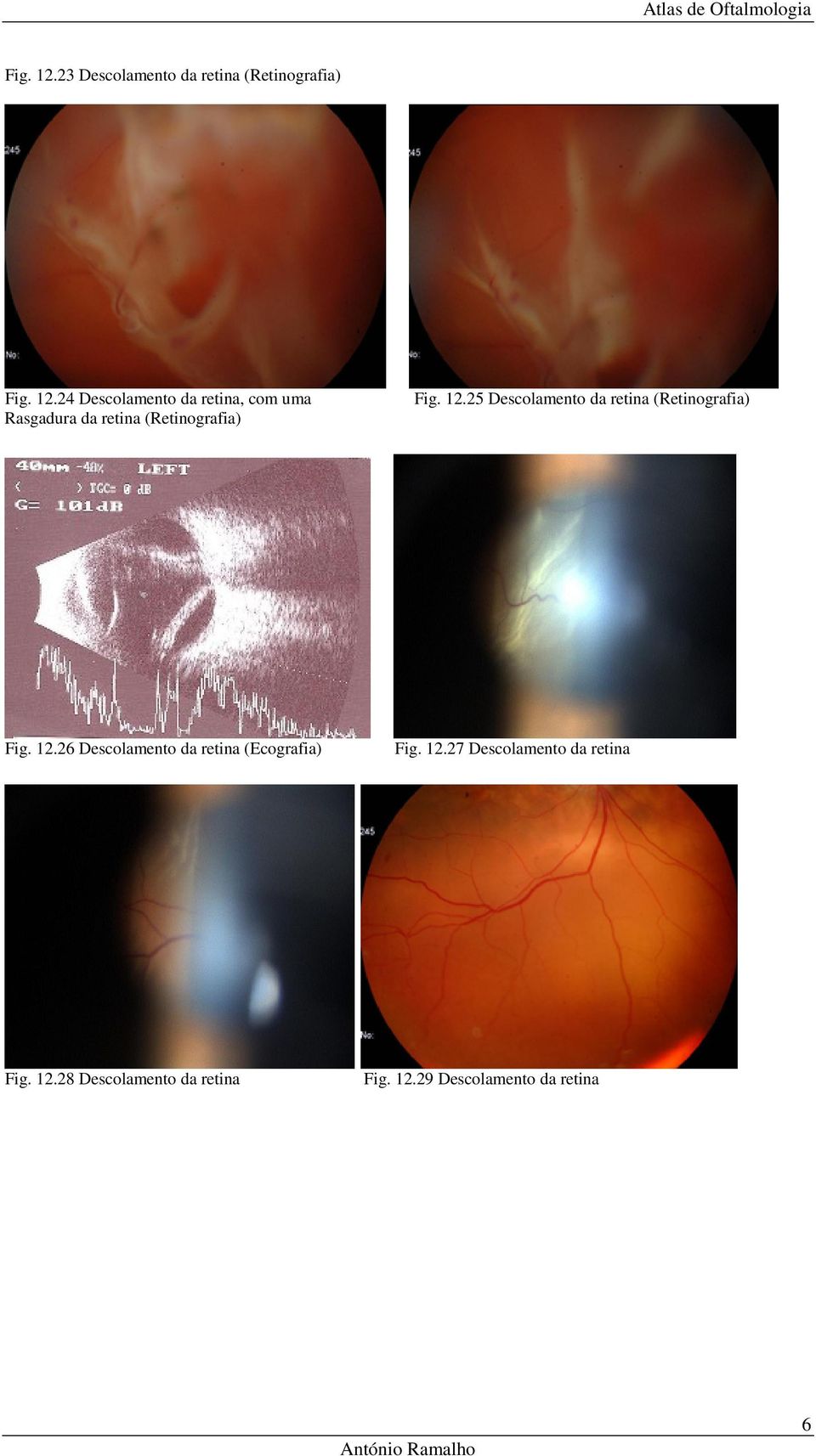 26 Descolamento da retina (Ecografia) Fig. 12.27 Descolamento da retina Fig. 12.28 Descolamento da retina Fig.
