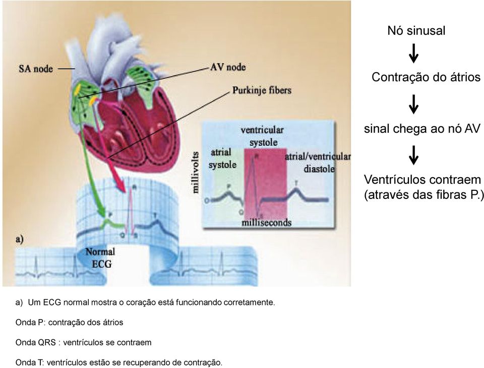 ) a) Um ECG normal mostra o coração está funcionando corretamente.