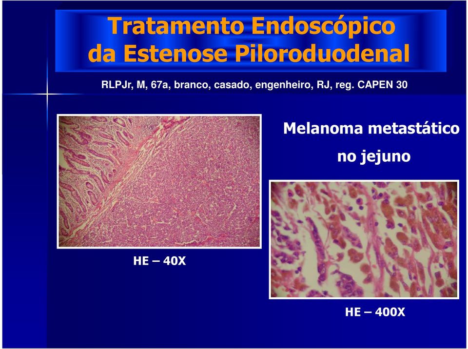 reg. CAPEN 30 Melanoma