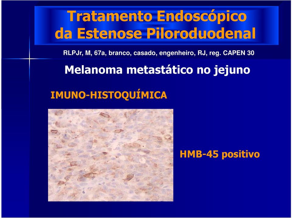 CAPEN 30 Melanoma metastático