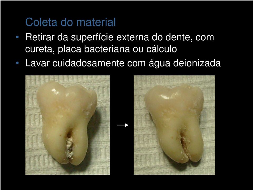 cureta, placa bacteriana ou