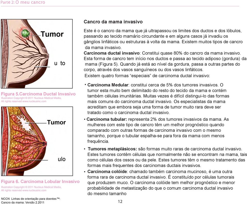 Esta forma de cancro tem início nos ductos e passa ao tecido adiposo (gordura) da mama (Figura 5).