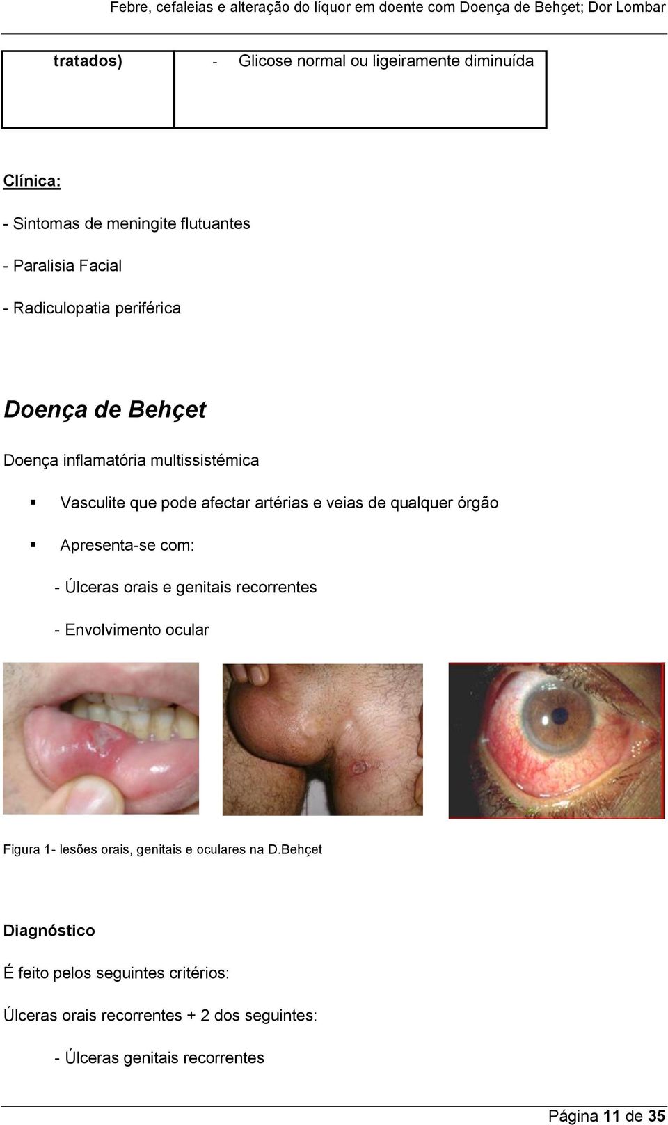 Apresenta-se com: - Úlceras orais e genitais recorrentes - Envolvimento ocular Figura 1- lesões orais, genitais e oculares na D.