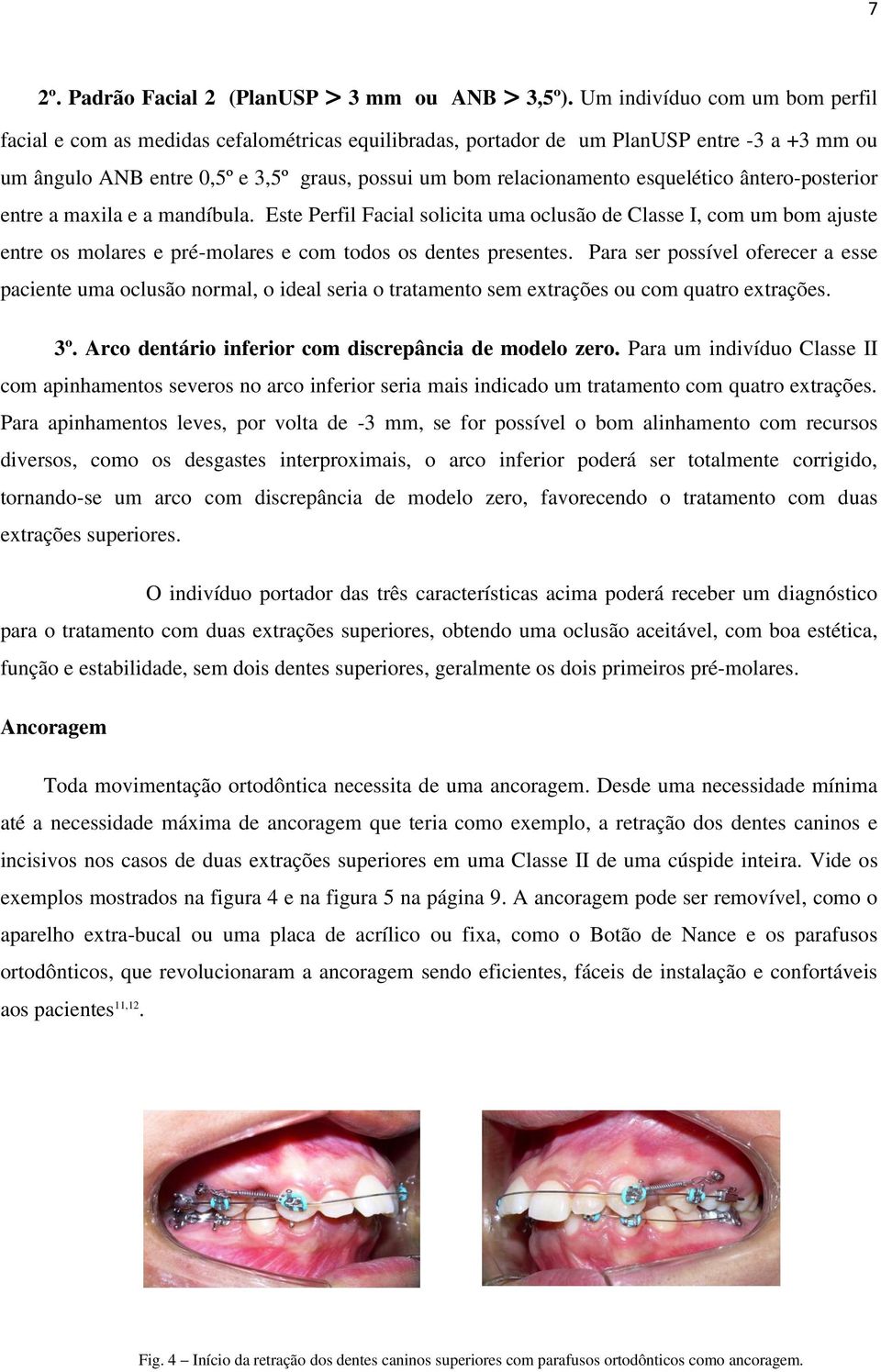 esquelético ântero-posterior entre a maxila e a mandíbula. Este Perfil Facial solicita uma oclusão de Classe I, com um bom ajuste entre os molares e pré-molares e com todos os dentes presentes.