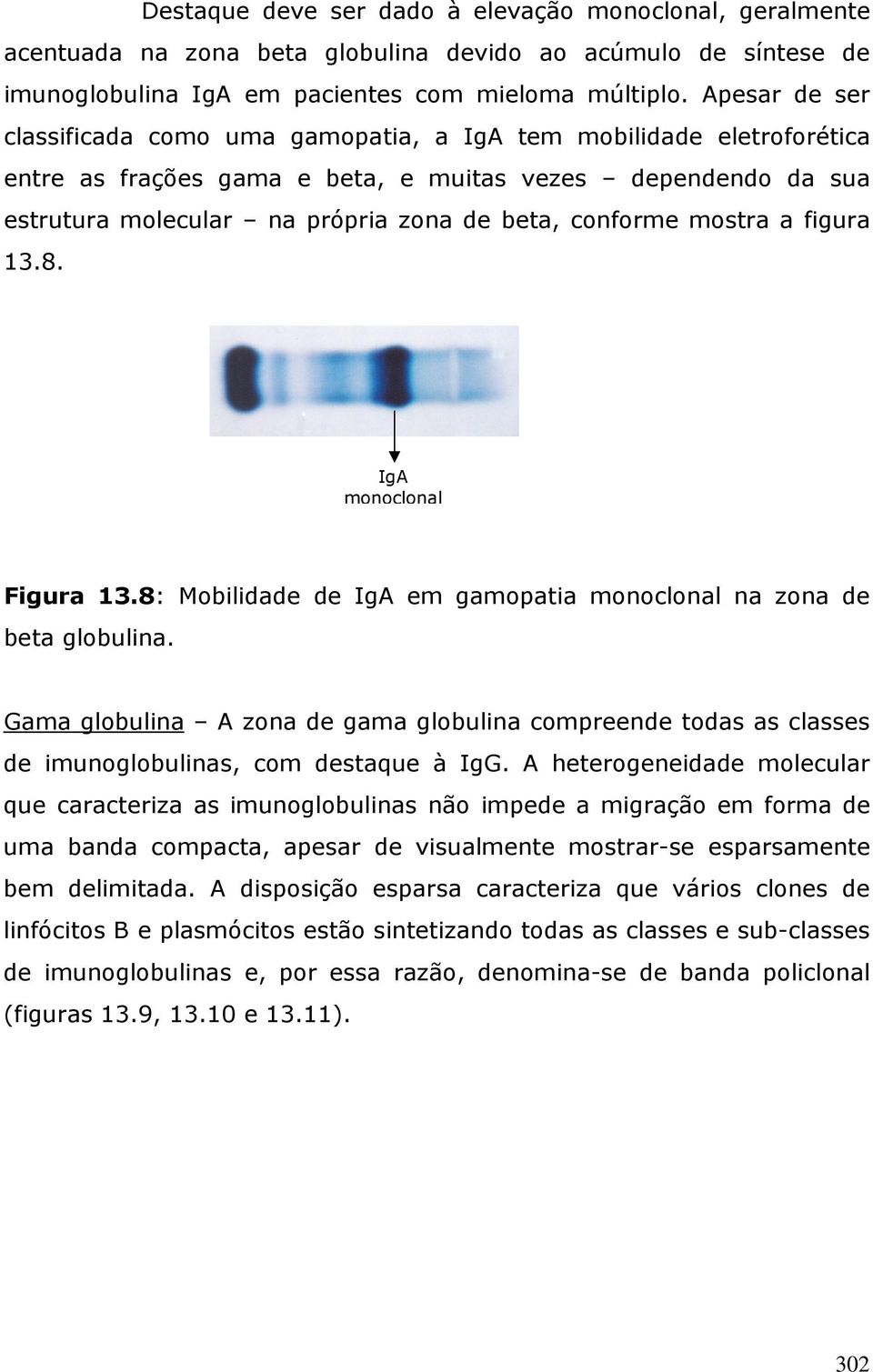 mostra a figura 13.8. IgA monoclonal Figura 13.8: Mobilidade de IgA em gamopatia monoclonal na zona de beta globulina.