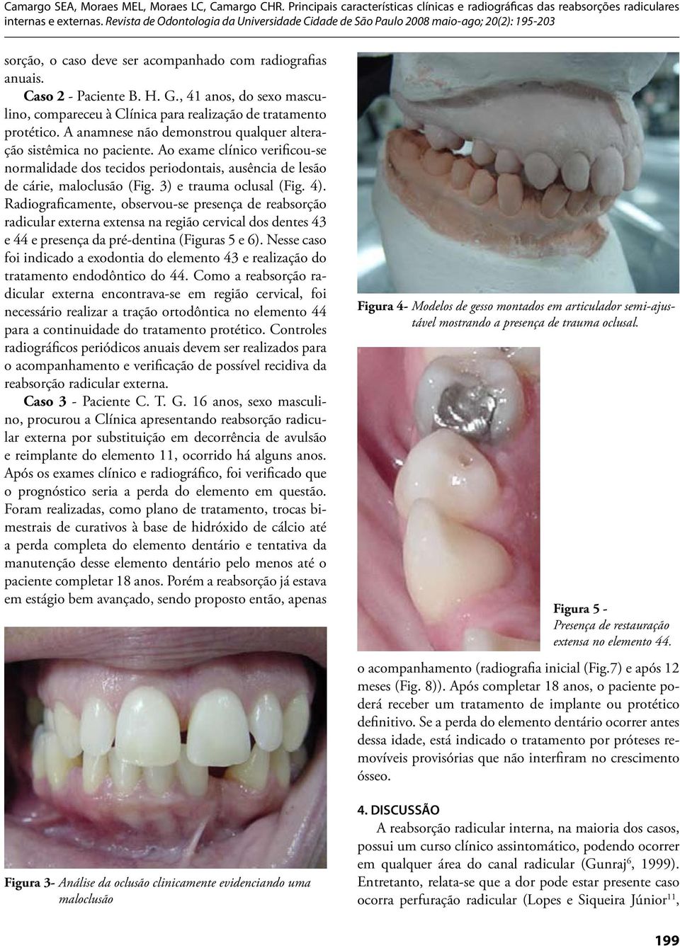 3) e trauma oclusal (Fig. 4). Radiograficamente, observou-se presença de reabsorção radicular externa extensa na região cervical dos dentes 43 e 44 e presença da pré-dentina (Figuras 5 e 6).