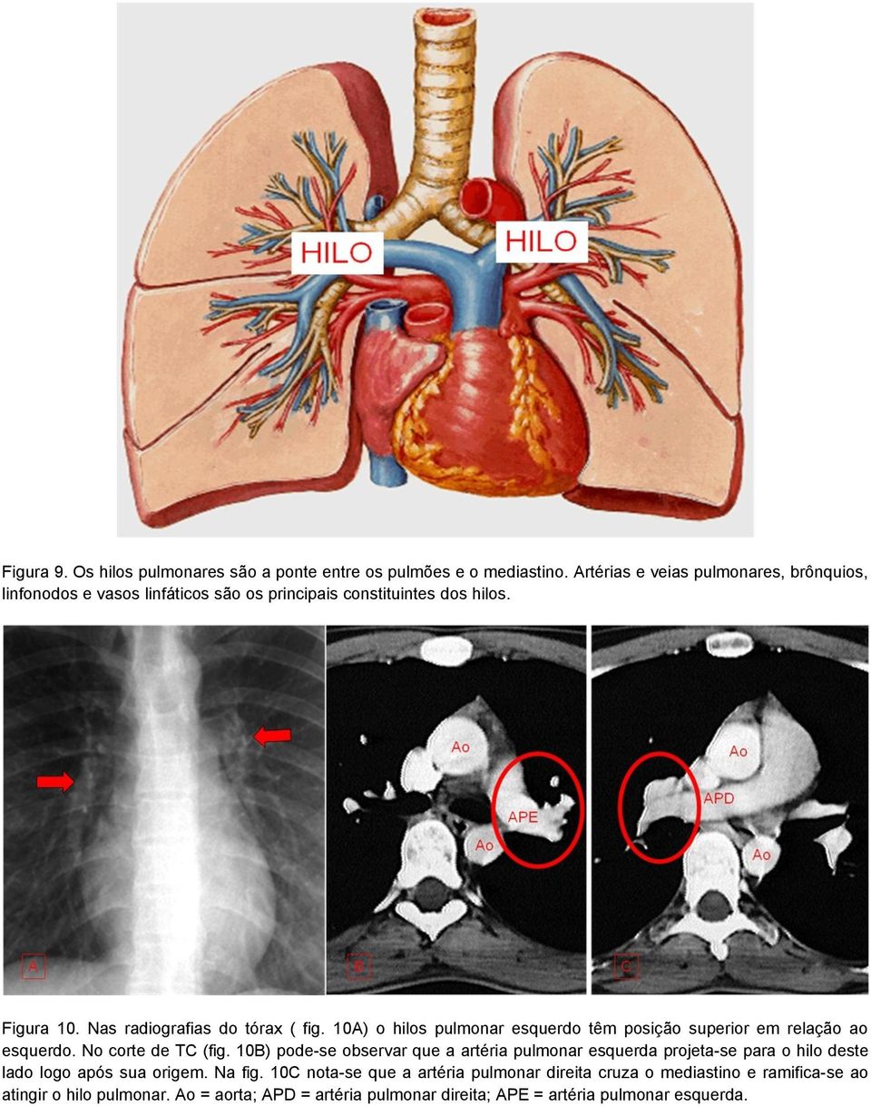 10A) o hilos pulmonar esquerdo têm posição superior em relação ao esquerdo. No corte de TC (fig.