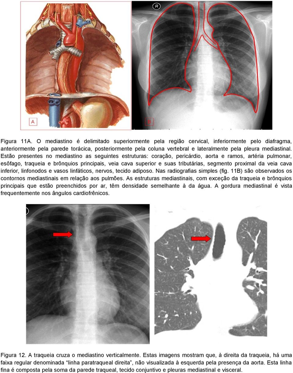 mediastinal.