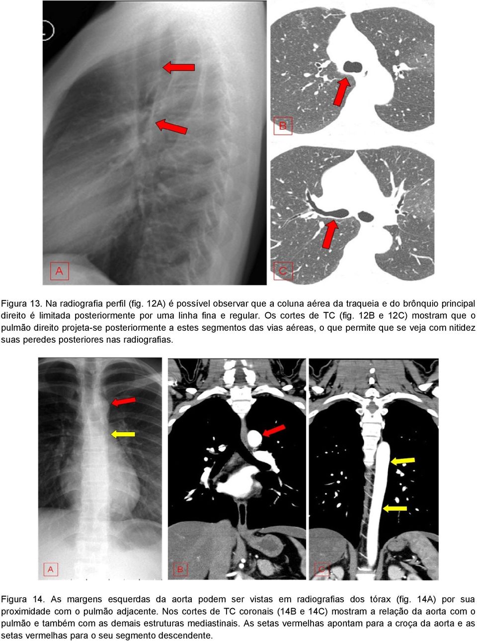 12B e 12C) mostram que o pulmão direito projeta-se posteriormente a estes segmentos das vias aéreas, o que permite que se veja com nitidez suas peredes posteriores nas radiografias.