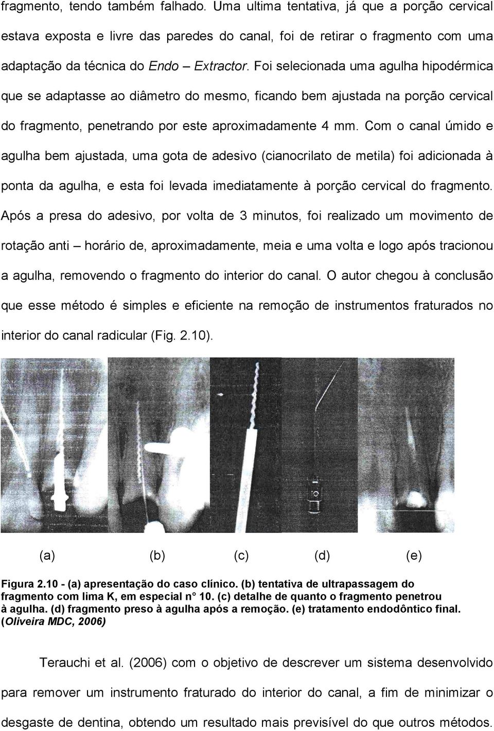 Com o canal úmido e agulha bem ajustada, uma gota de adesivo (cianocrilato de metila) foi adicionada à ponta da agulha, e esta foi levada imediatamente à porção cervical do fragmento.