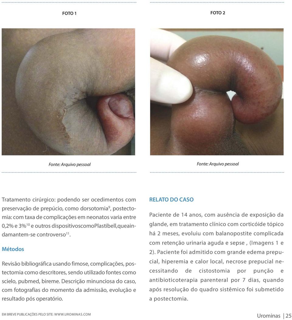 Métodos Revisão bibliográfica usando fimose, complicações, postectomia como descritores, sendo utilizado fontes como scielo, pubmed, bireme.