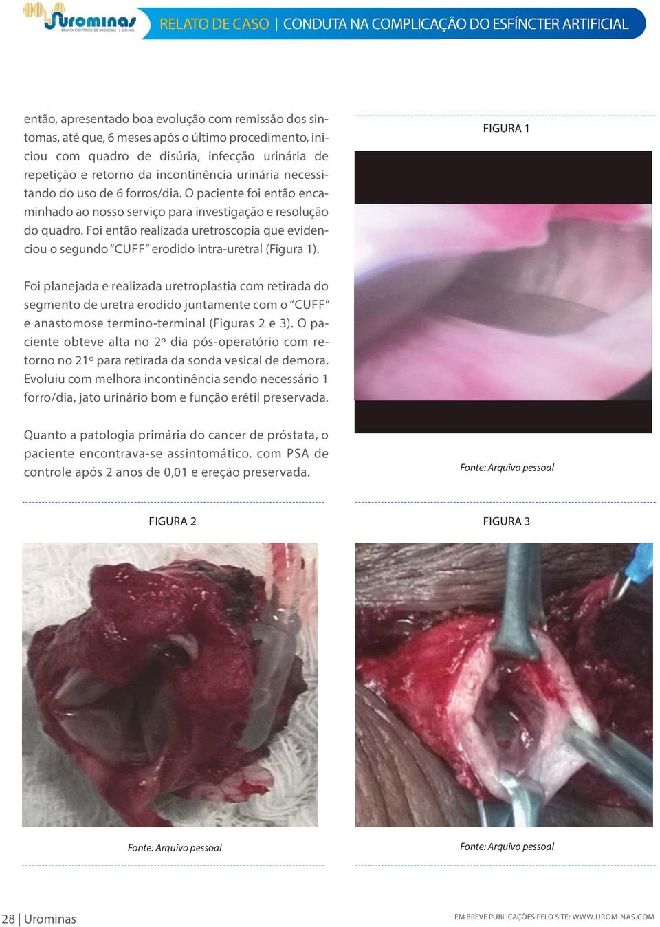 Foi então realizada uretroscopia que evidenciou o segundo CUFF erodido intra-uretral (Figura 1).