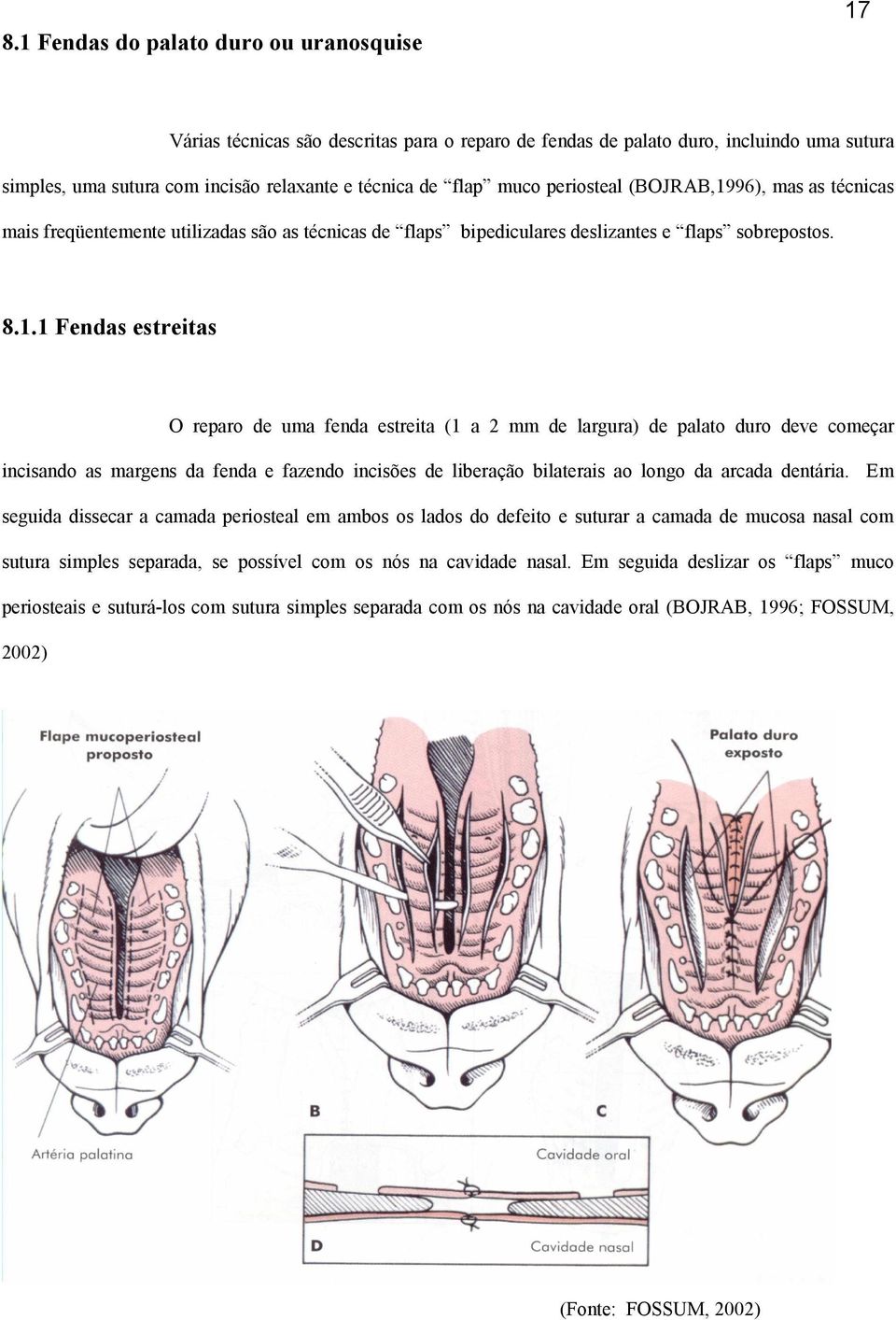 96), mas as técnicas mais freqüentemente utilizadas são as técnicas de flaps bipediculares deslizantes e flaps sobrepostos. 8.1.