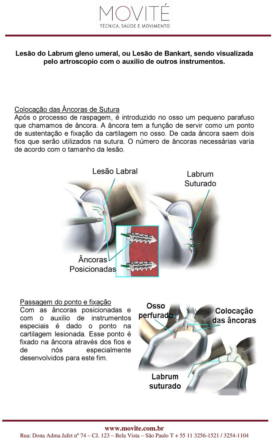 A âncora tem a função de servir como um ponto de sustentação e fixação da cartilagem no osso. De cada âncora saem dois fios que serão utilizados na sutura.