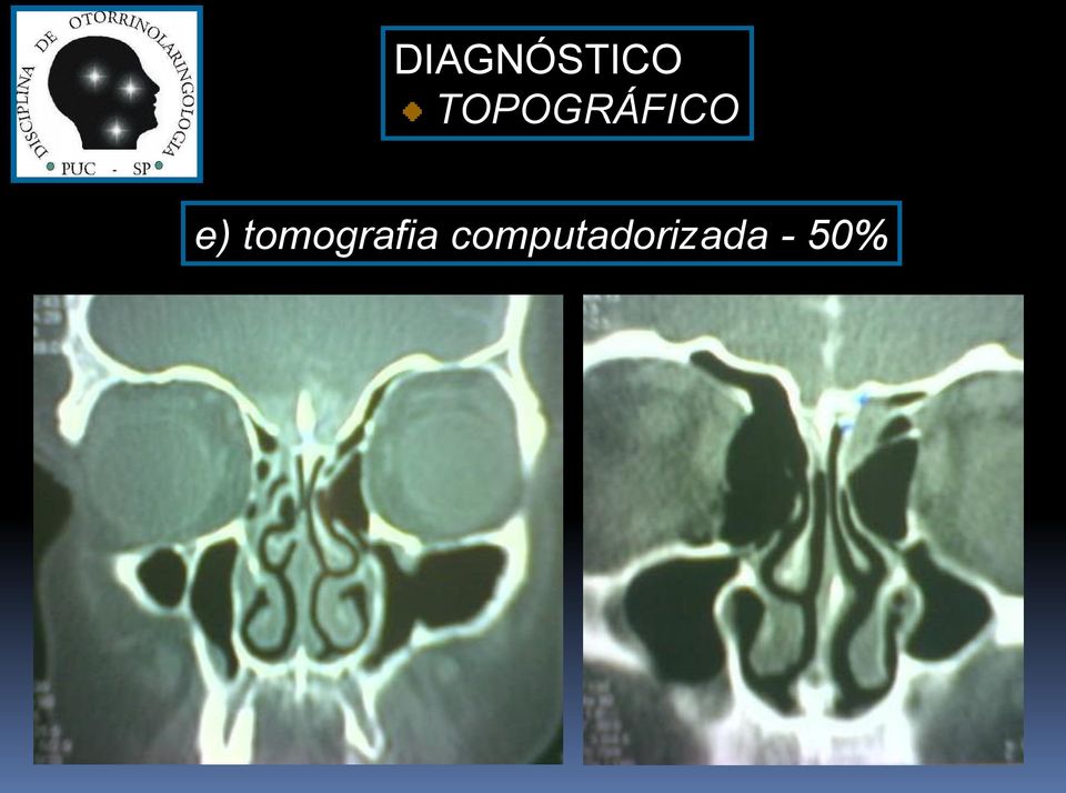 tomografia